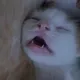 sedation
